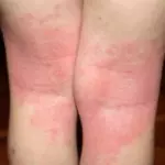 атопический дерматит под коленками